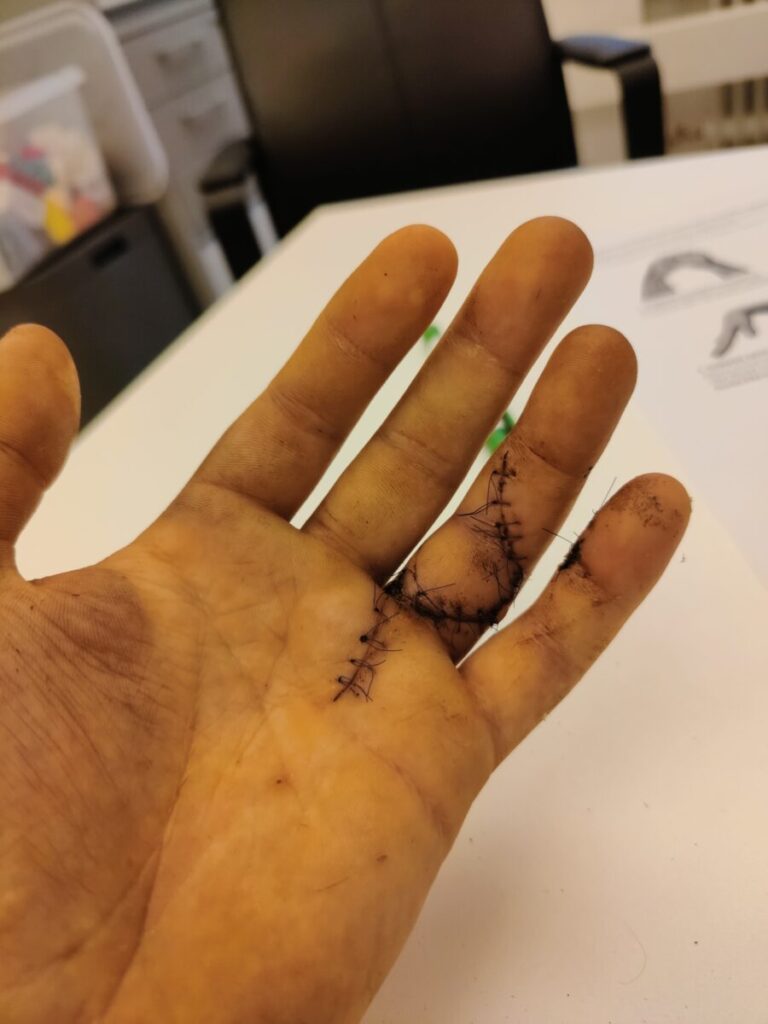 Äskeisen kuona seulan kanssa kesällä sattui pieni tapaturma.